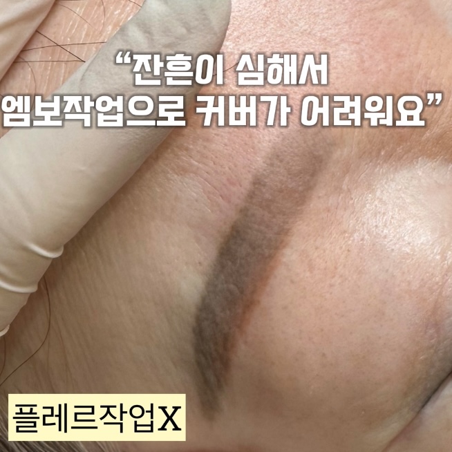 잔흔이 심해서 엠보작업으로 커버가 어려운 케이스 클로즈업